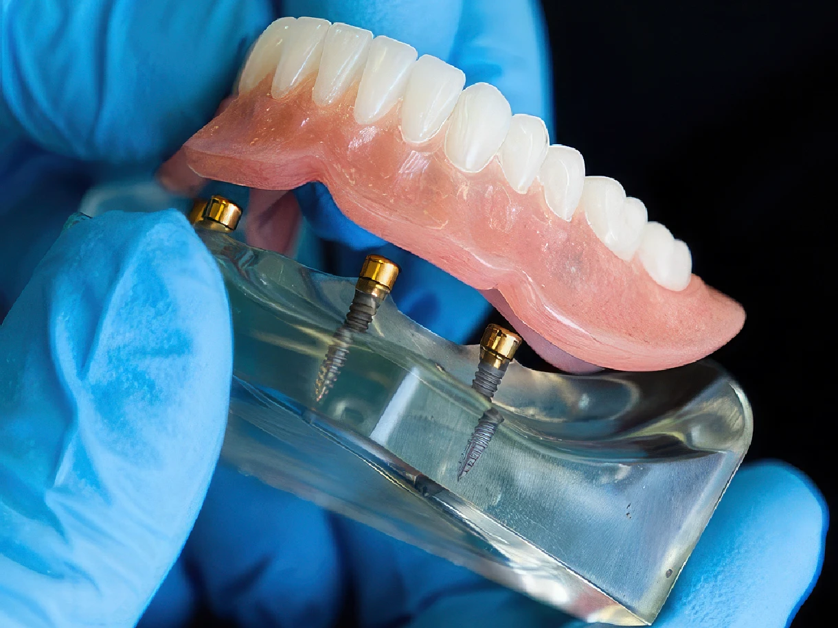 2-implant lower snap in implant denture