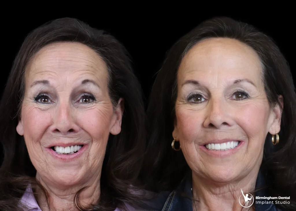 Before and after dental implants