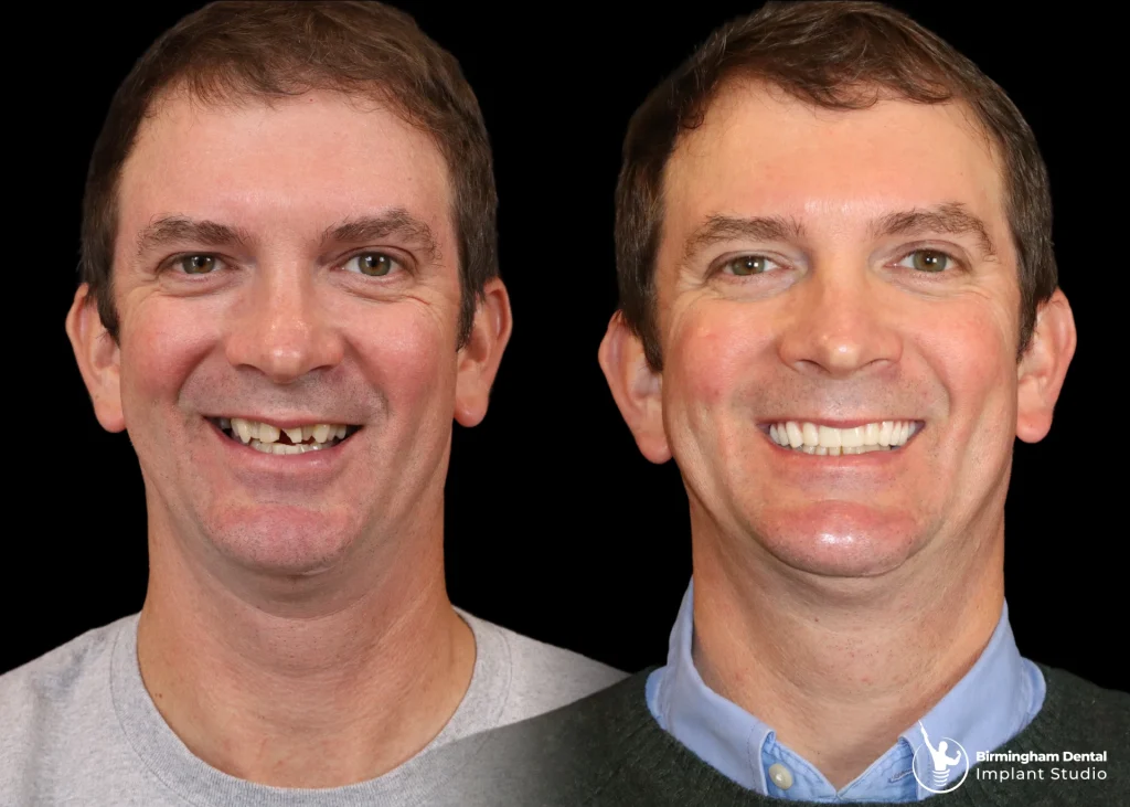 Before and after dental implants