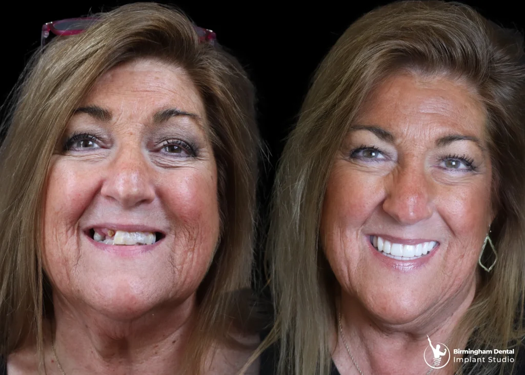 Before and after dental implants