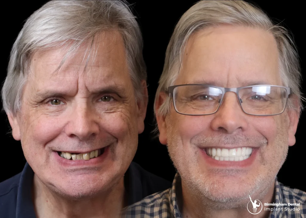 Before and after dental implants