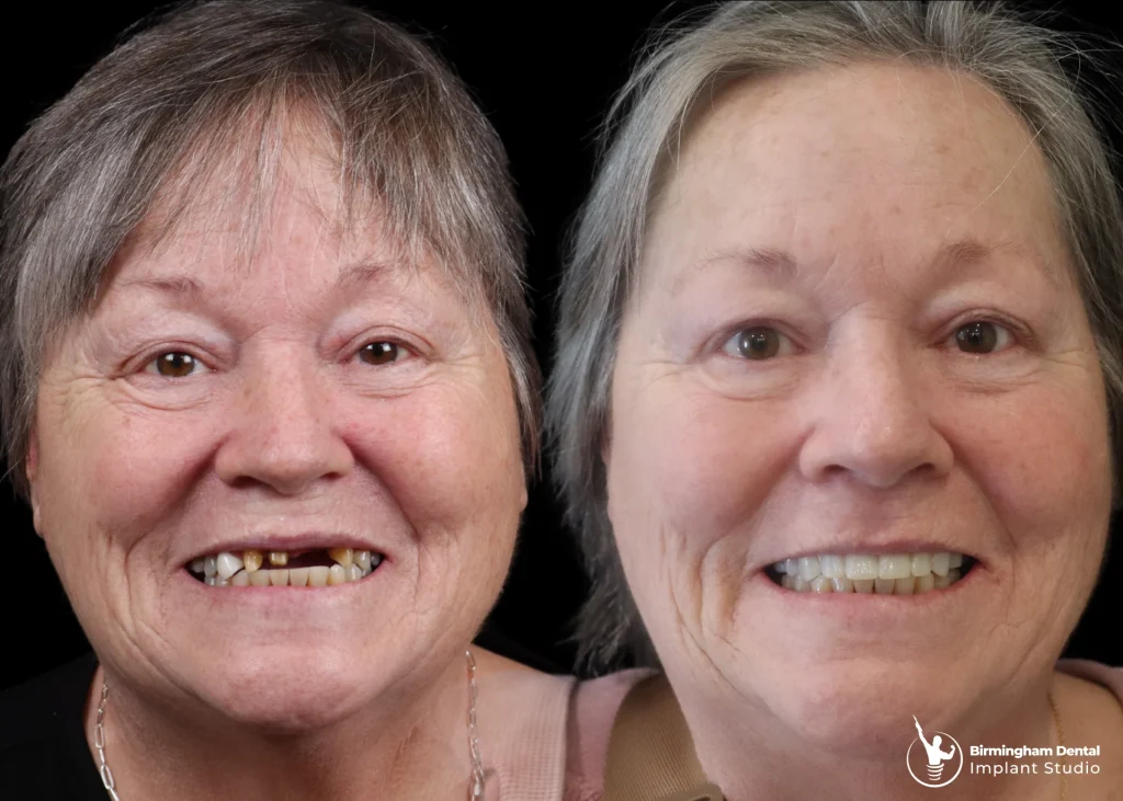Before and after dental implants