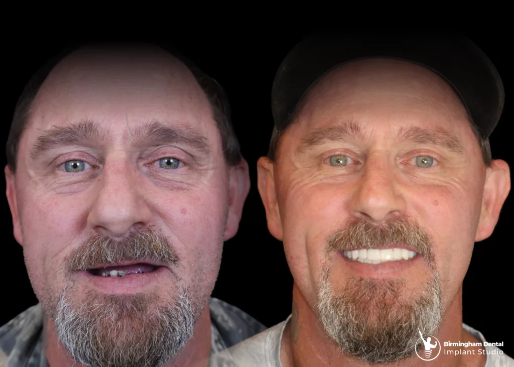 Before and after dental implants