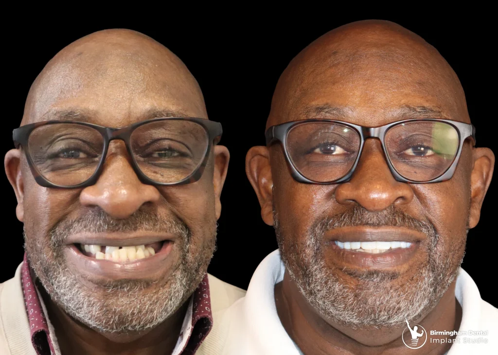 Before and after dental implants