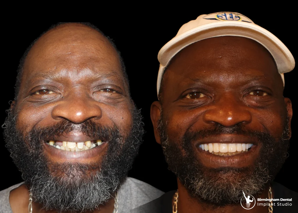 Before and after dental implants