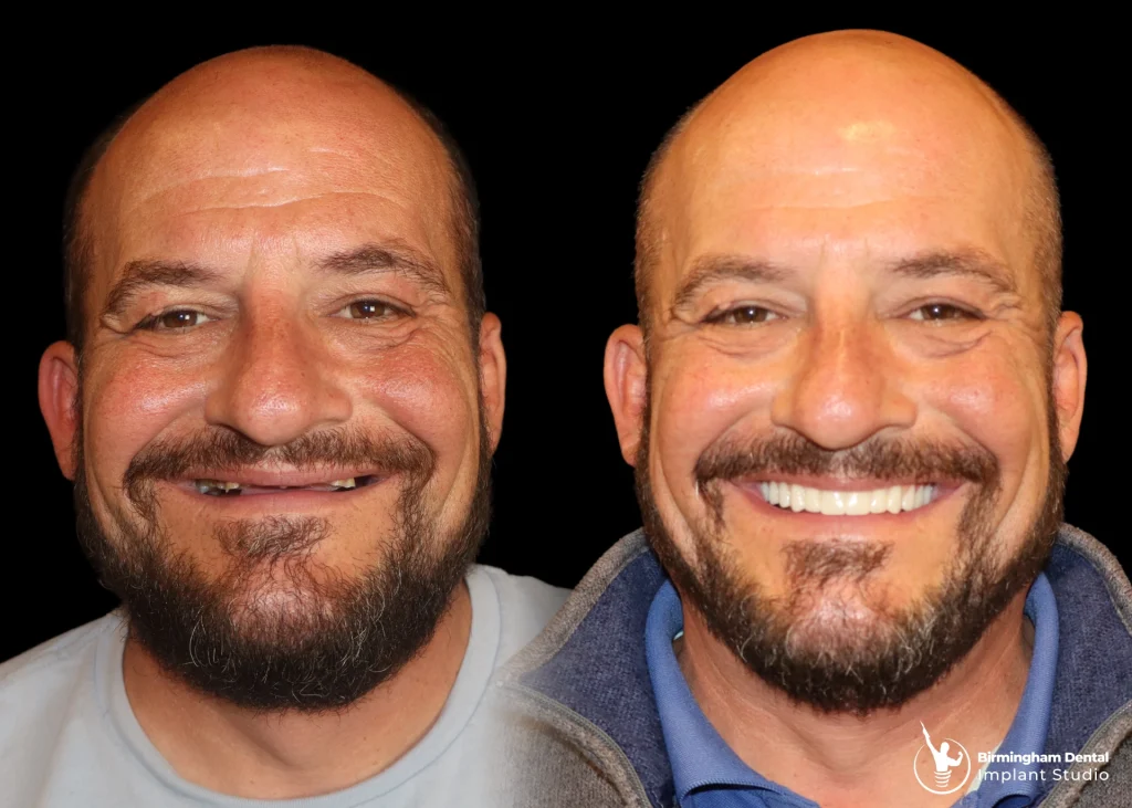 Before and after dental implants
