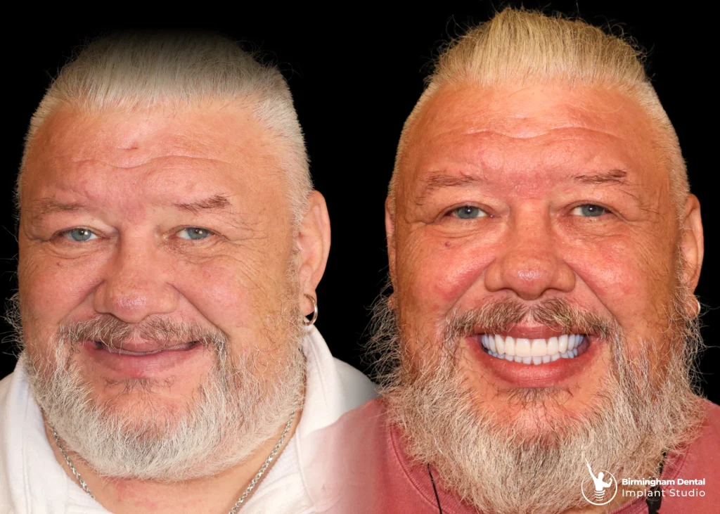 Before and after dental implants