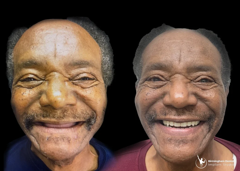 Before and after dental implants