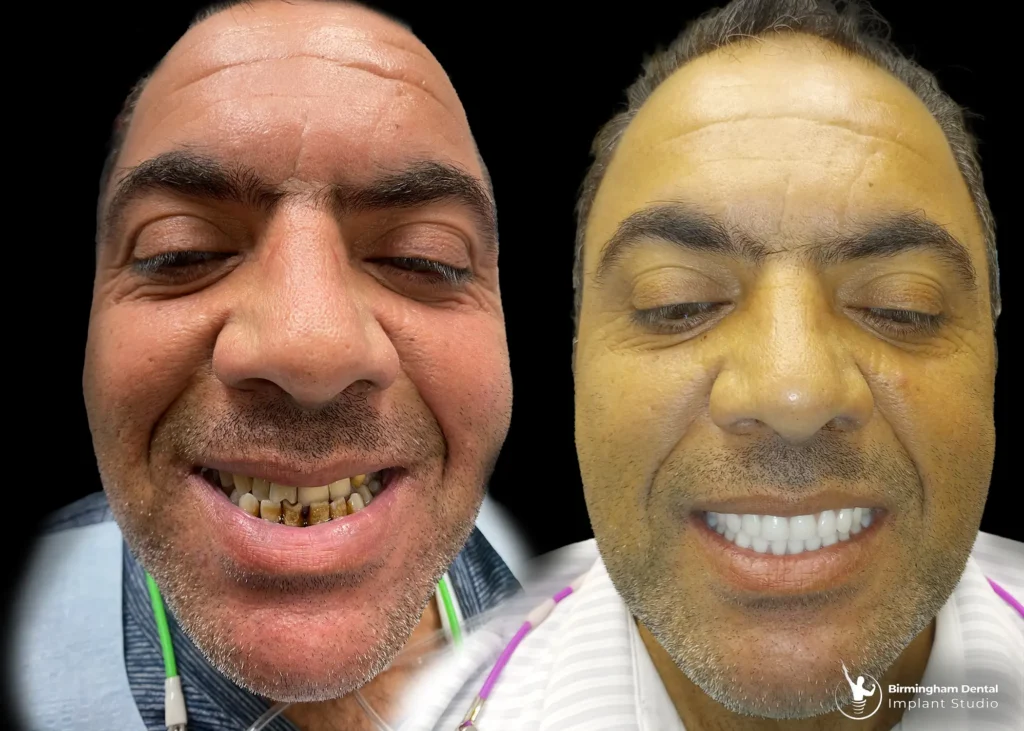 Before and after dental implants