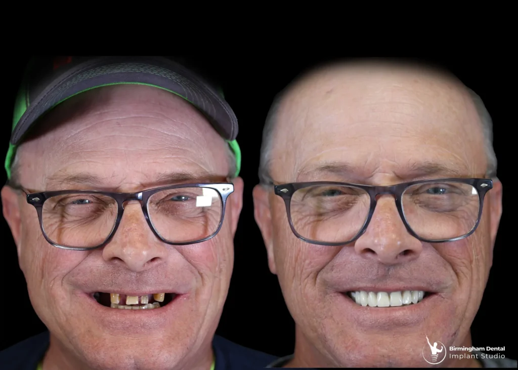 Before and after dental implants