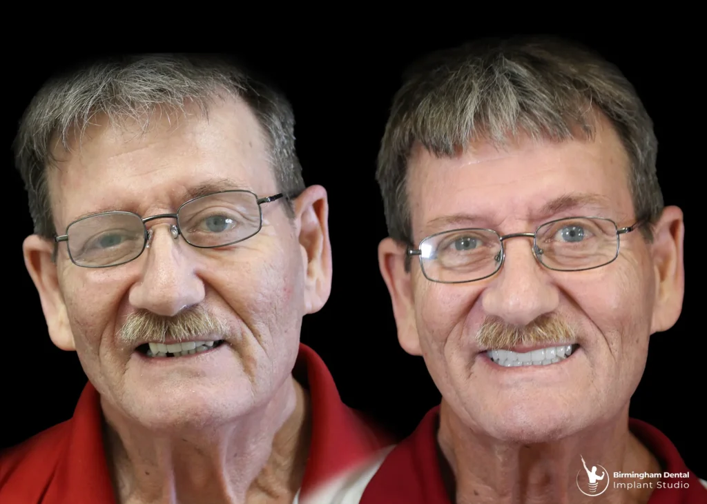 Before and after dental implants