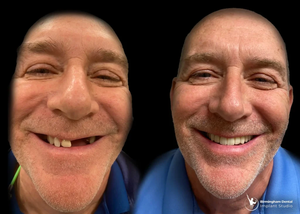 Before and after dental implants
