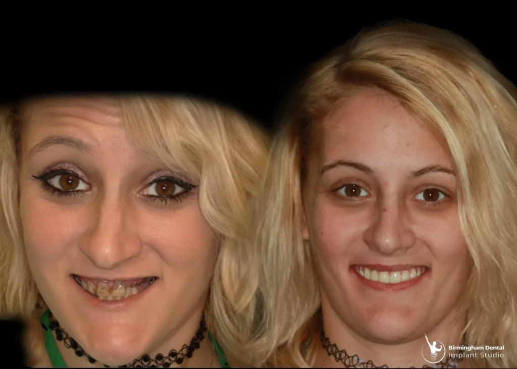 Before and after dental implants