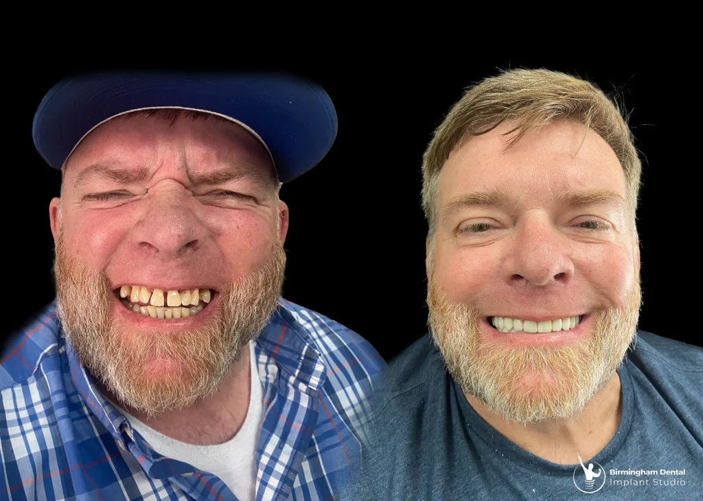 Before and after dental implants