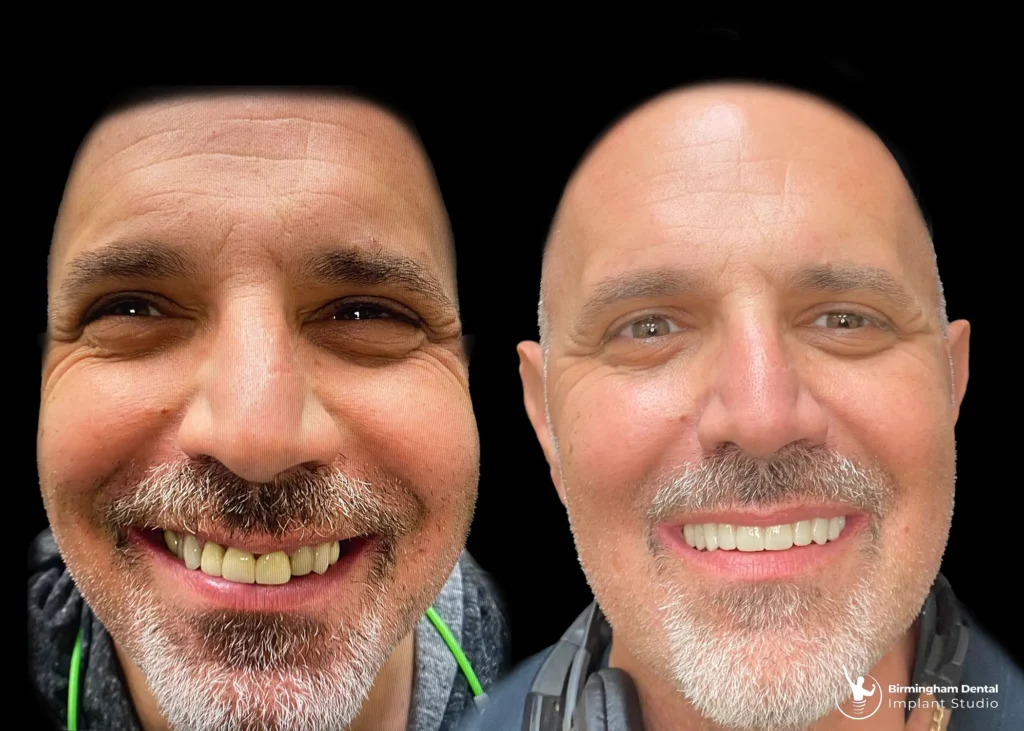 Before and after dental implants