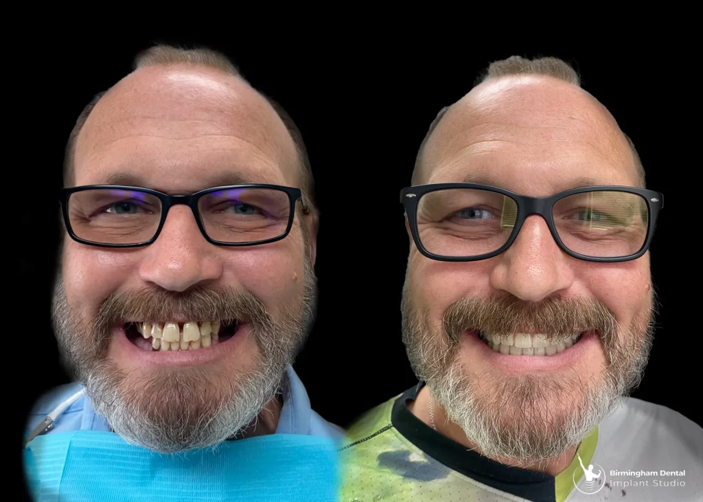 Before and after dental implants