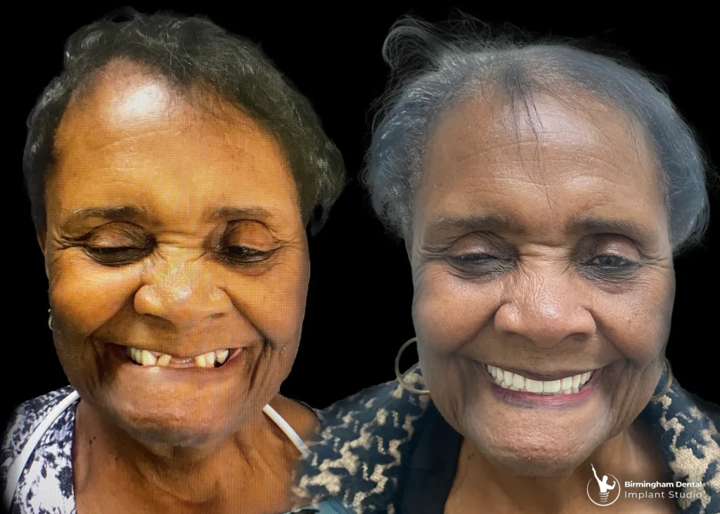 Before and after dental implants