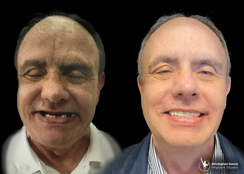 Before and after dental implants