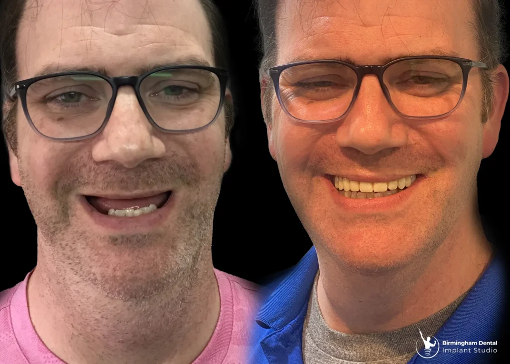 Before and after dental implants