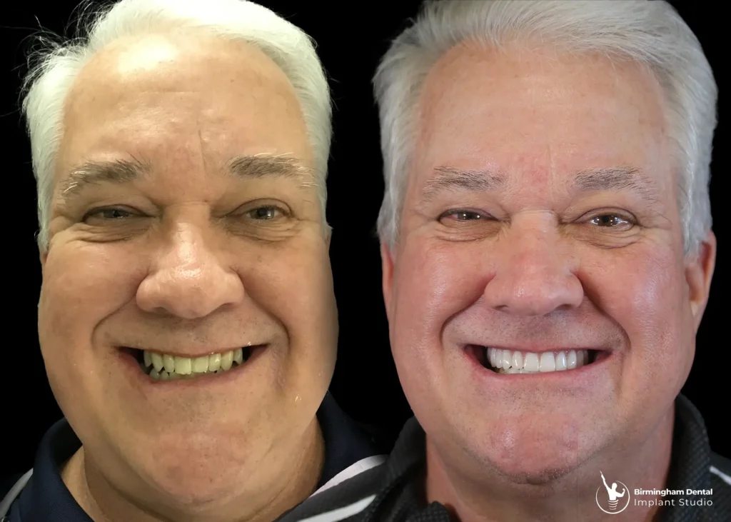Before and after dental implants