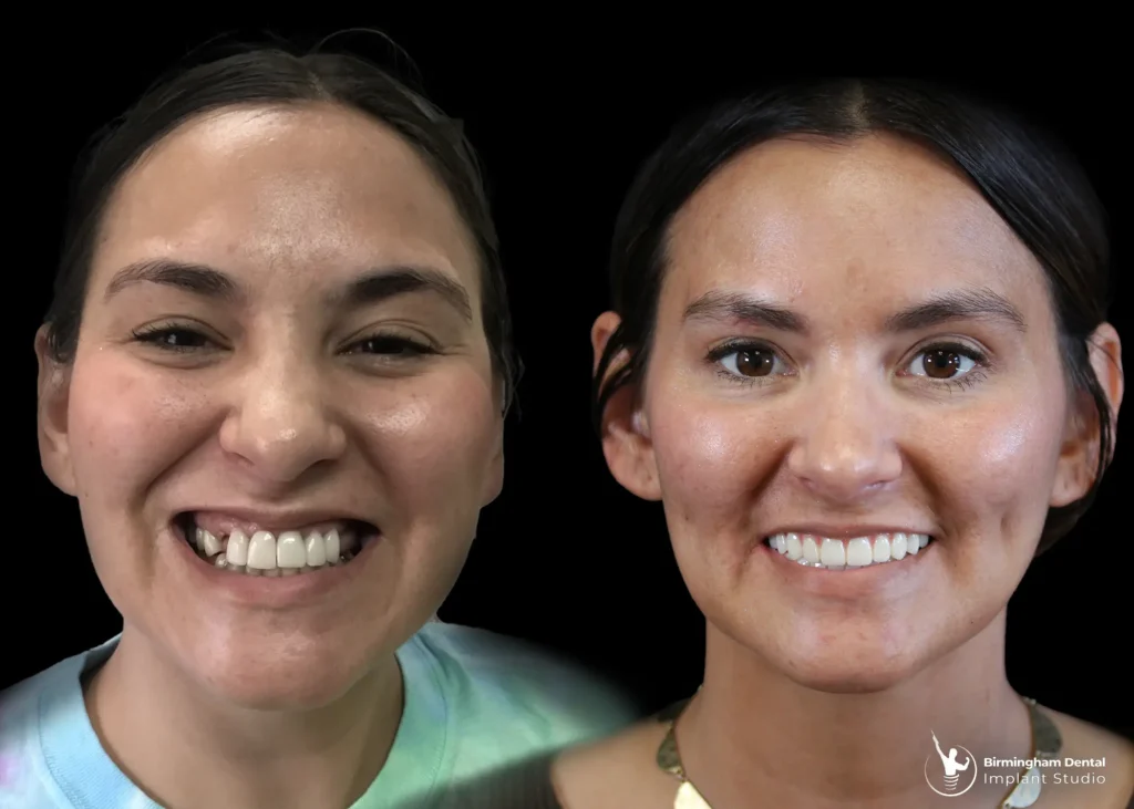 Before and after dental implants