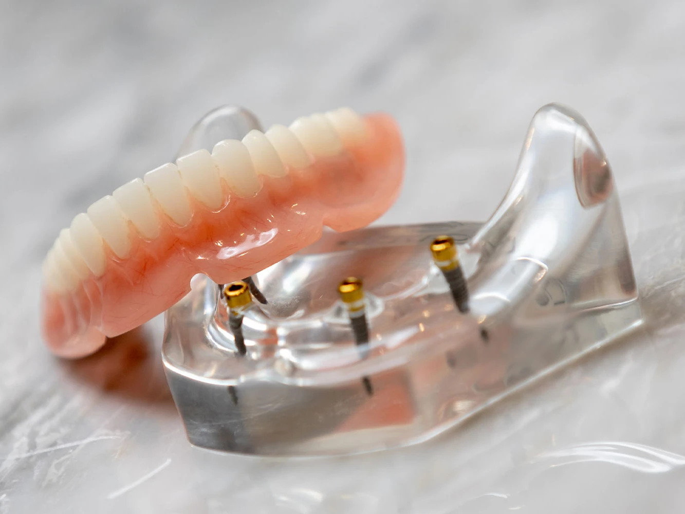 3D illustration of jaw with snap-in implant dentures