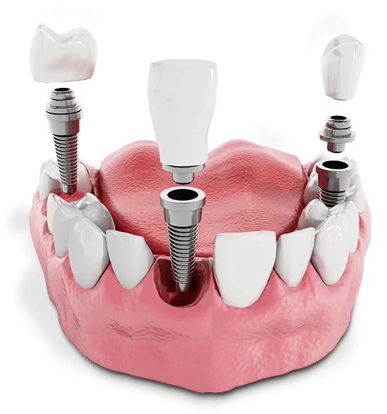 Model of single tooth implants
